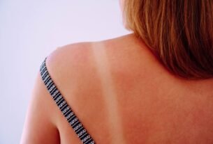 COMO CUIDAR DA PELE APÓS EXPOSIÇÃO SOLAR? • Beleza com saúde