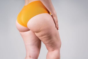 Celulite: tipos, causas e tratamentos