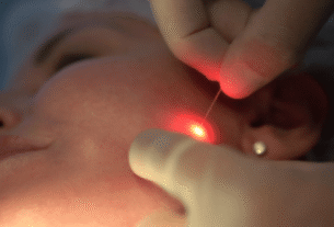 Quem disse que é só a Coreia? Laser da Itália promete acabar com gordura localizada e flacidez, sem cortes