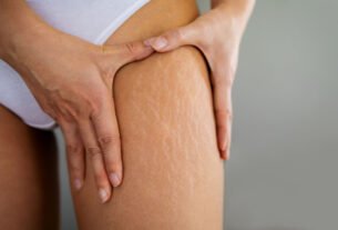 Estrias: saiba como elas surgem e como trata