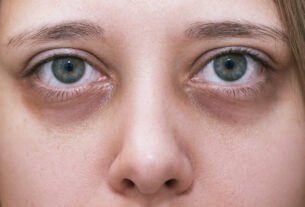 Dermatologistas ensinam como tratar os diferentes tipos de olheiras