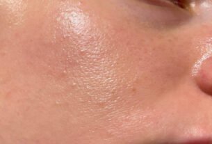 Pele oleosa? Dermatologista explica como deve ser rotina de skincare