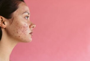 O verão está chegando! Saiba como cuidar da acne na estação
